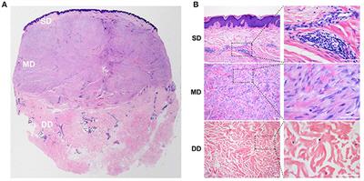 The Superficial Dermis May Initiate Keloid Formation: Histological Analysis of the Keloid Dermis at Different Depths